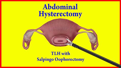 abdominal hysterectomy in chesterfield|Top.
